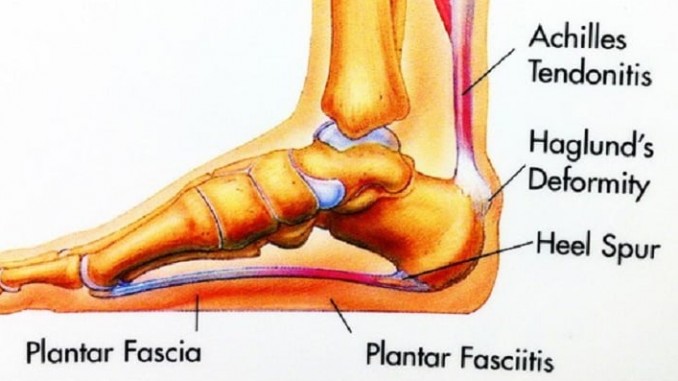 Have You Considered Rolfing For Plantar Fasciitis Treatment?