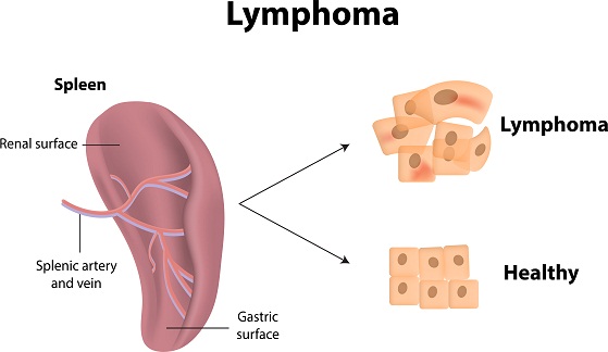 Lymphoma Symptoms And Causes