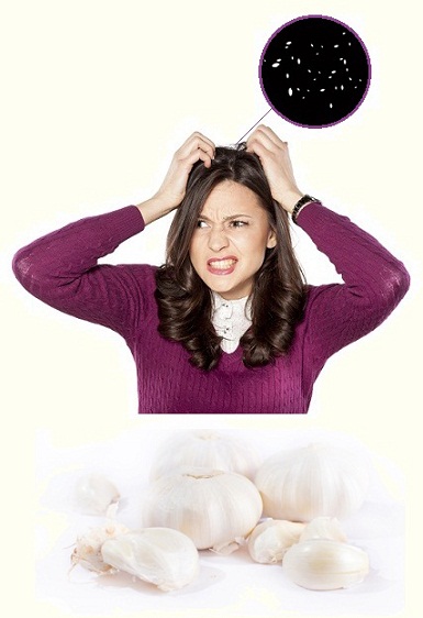 Uses and Benefits of Garlic for Dandruff