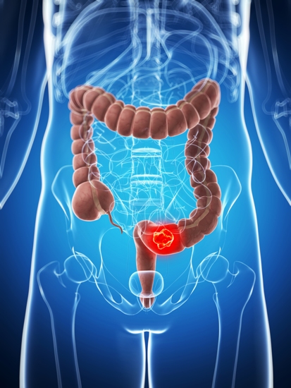 Causes And Symptoms Of Colon Cancer